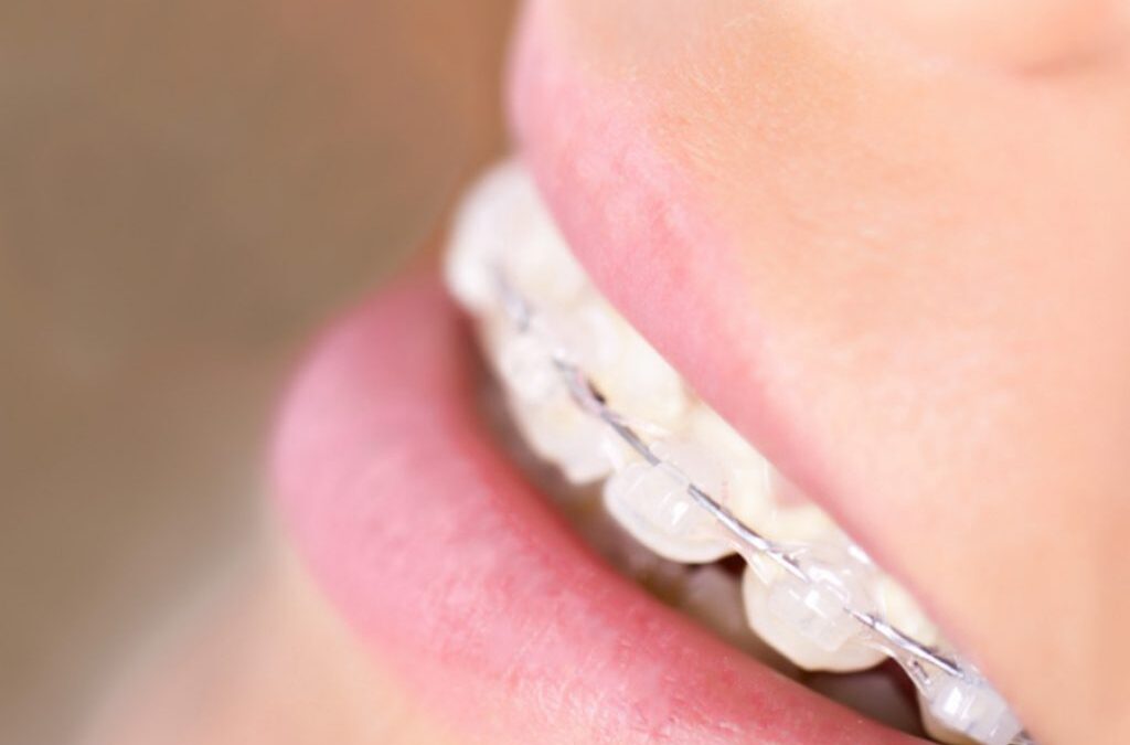 Apparecchio per bambini: quando, come e perché?